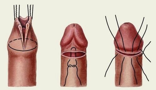 esencja operacji powiększania penisa