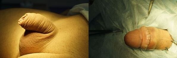 penisa przed i po operacji powiększania