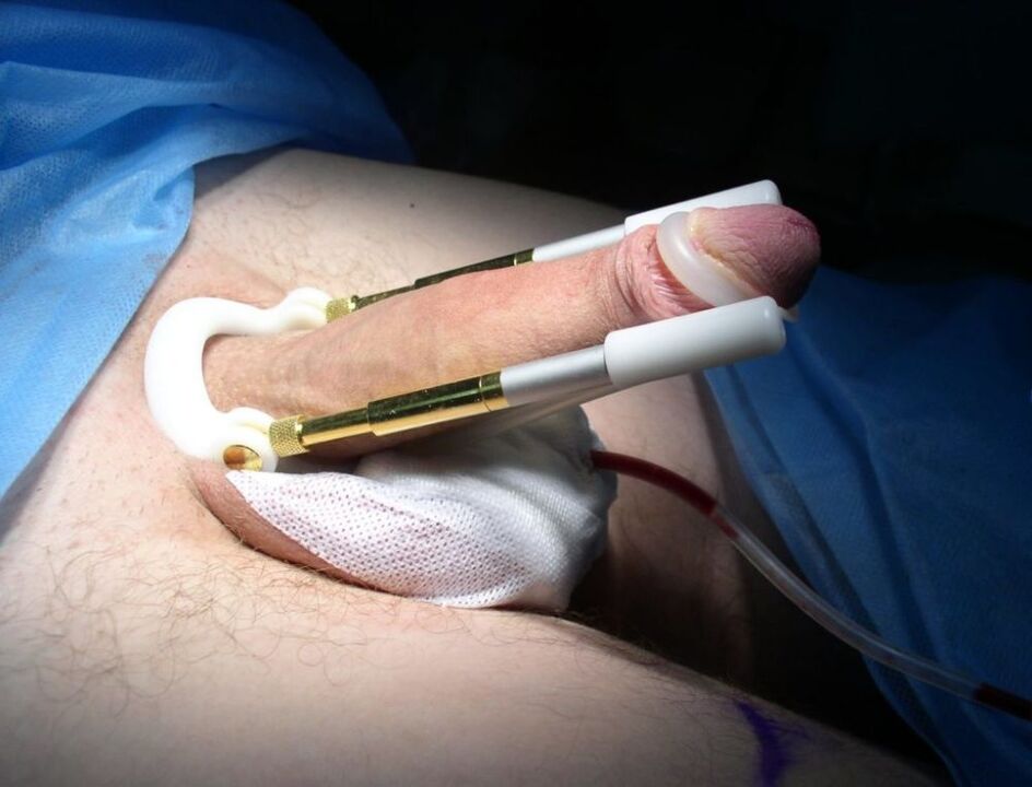 przedłużacz po operacji powiększania penisa