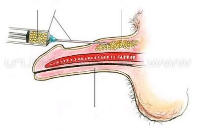 zastrzyk powiększający penisa